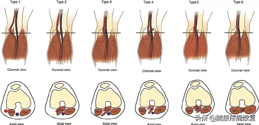 老人小腿疼痛是什么原因,脚小腿肌肉疼痛是什么原因