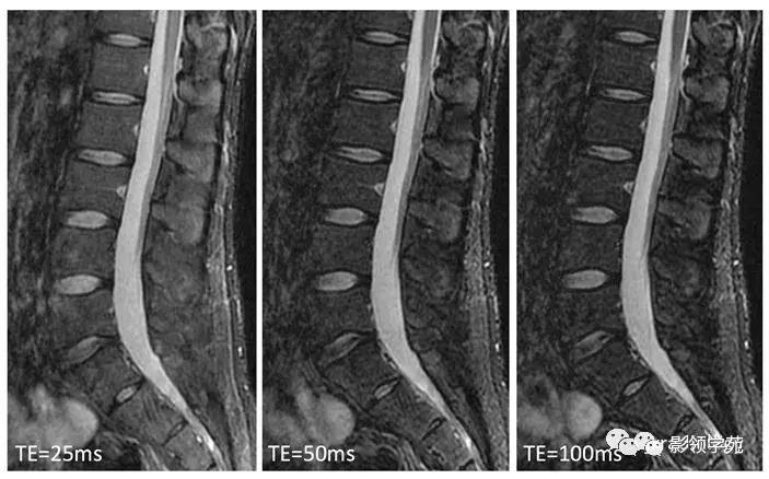 9种椎体和椎旁信号增高的非肿瘤性病变