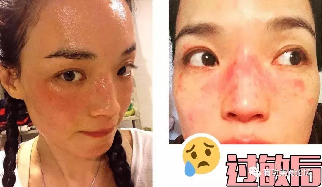 过敏的化妆品怎样处理,过敏性皮炎化妆品过敏怎么办