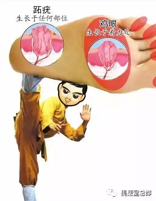 鸡眼跖疣肉刺三者之间有什么区别,跖疣鸡眼和胼胝的区别