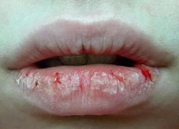 怀孕嘴巴里长血管瘤的女人,怀孕后嘴唇上长血管瘤