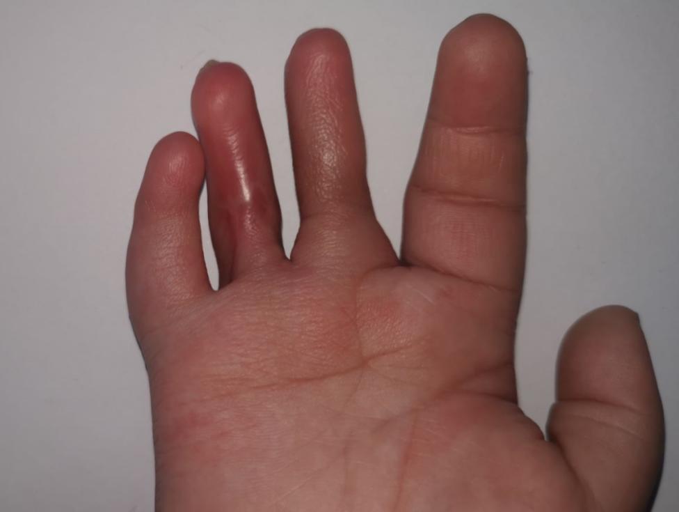 并指畸形免植皮案例,并指畸形