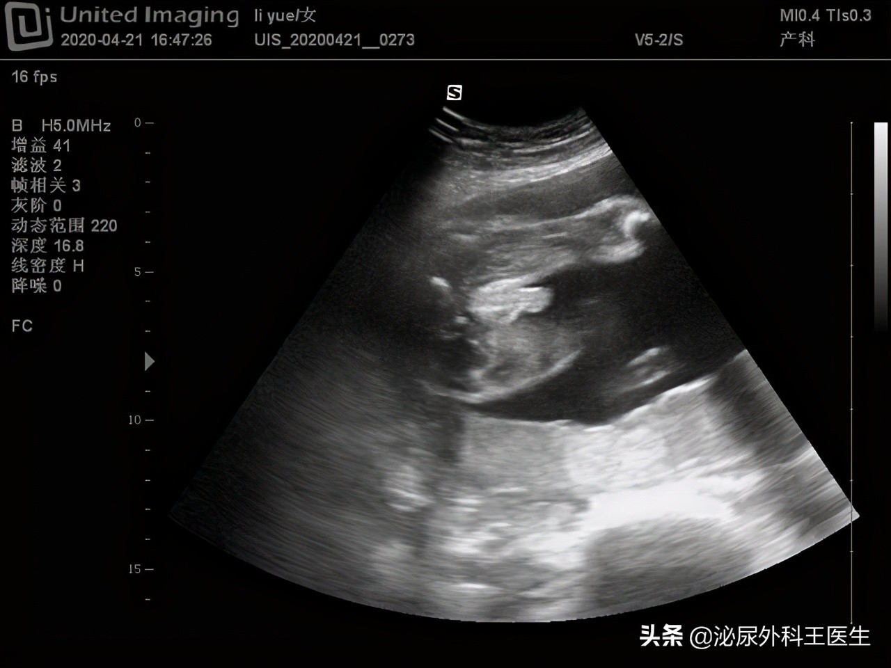 阴式b超检查前需要注意事项,什么是阴式b超检查