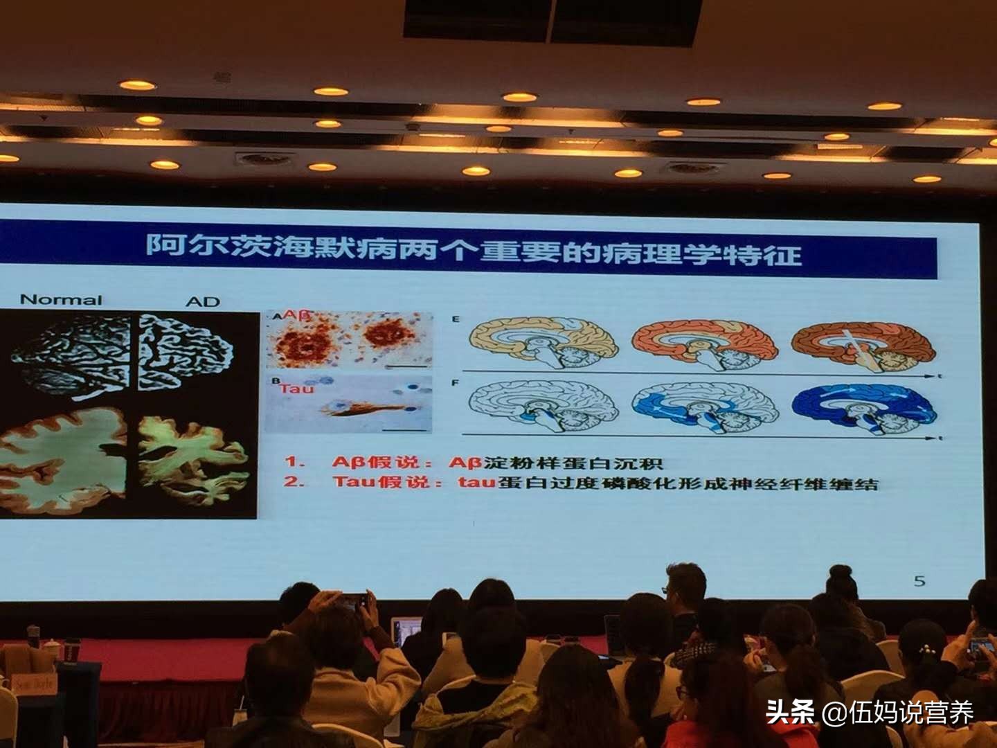 苏大强阿尔茨海默症症状,苏大强得了阿尔茨海默症