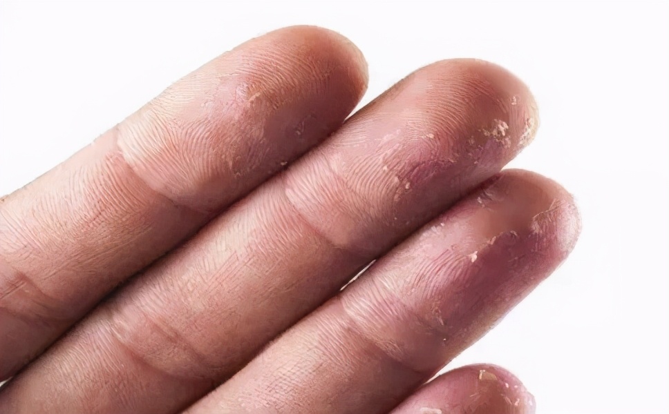 手脱皮是因为缺维生素吗,手脱皮主要是怎么造成的