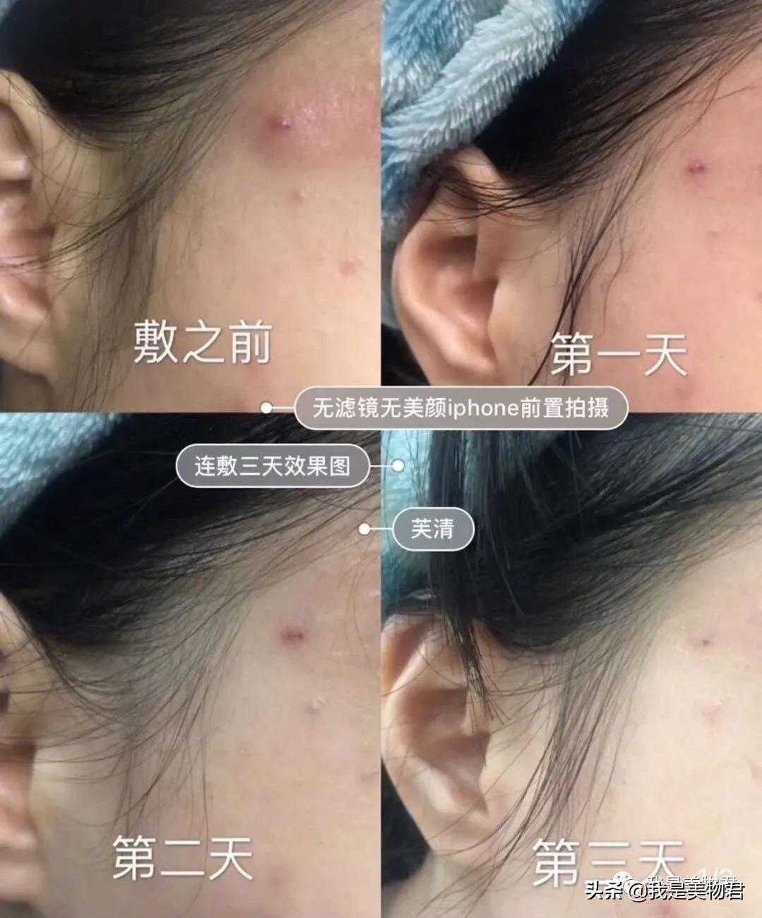 痘痘肌用什么医美面膜,医美面膜测评痘痘肌