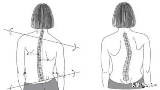高低肩怎么自我矫正学会这几招,高低肩怎么自我矫正健身
