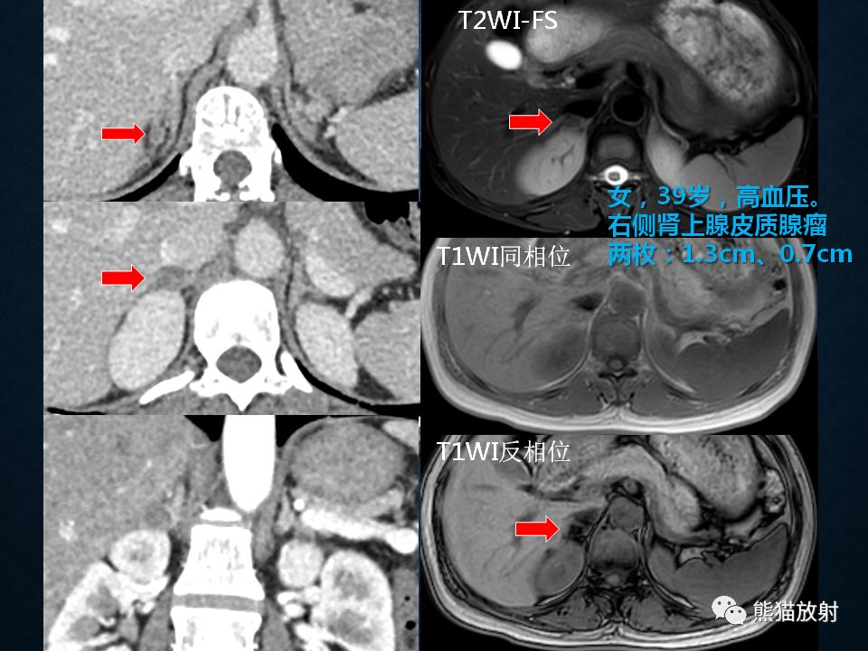 纵隔和肾上腺恶性肿瘤,纵隔性肿瘤位置图