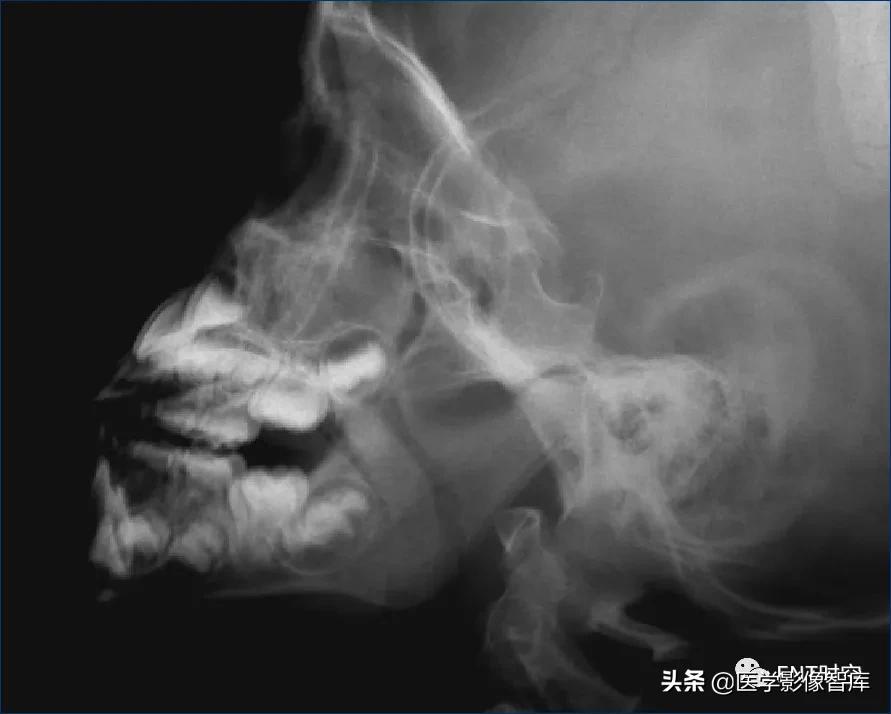 腺样体肥大有必要做x射线复查吗,最简单检测腺样体肥大的方法