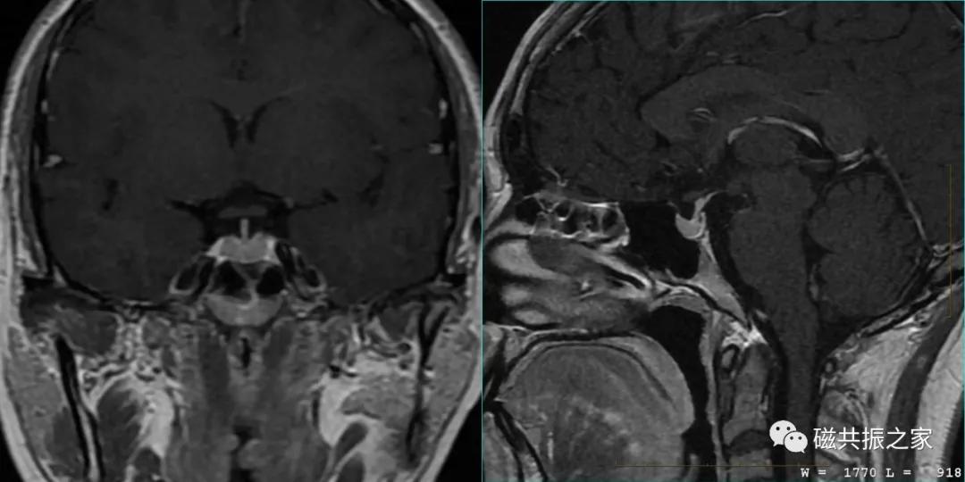 垂体mri扫描,垂体微腺瘤mri扫描