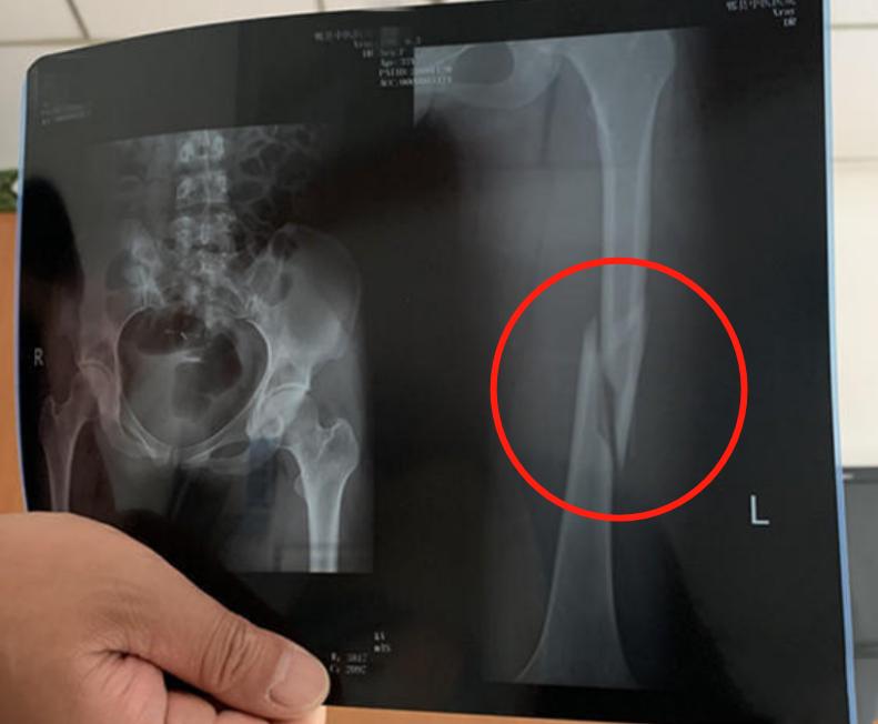 瑜伽拉伸时突然一阵剧痛，女子索赔20万，丈夫：家里没有经济来源