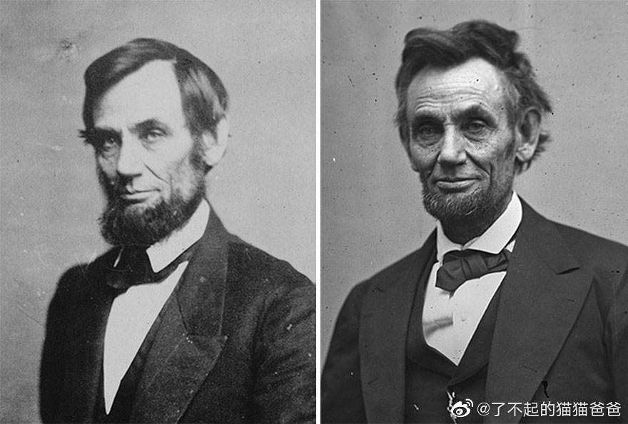 主动脉夹层动脉瘤微创治疗,主动脉夹层动脉瘤破裂出血