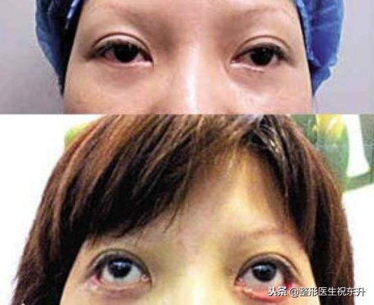 割眼袋导致下睑外翻怎么修复,祛眼袋以后凹陷的原因