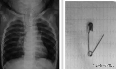 儿童消化道异物处理,小孩吃了耳环塞异物怎么办