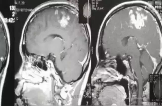 女孩脑中的寄生虫,20岁女孩脑袋有寄生虫后续