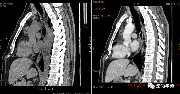 纵隔和肾上腺恶性肿瘤,纵隔性肿瘤位置图
