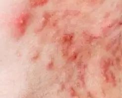 前胸后背痘痘怎么去除,后背痘痘多什么原因及怎么祛除