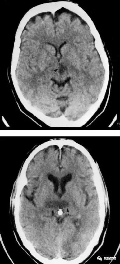 脑梗死丨演变、血供区域分布、CT表现