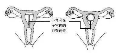 【健康】2600万被遗忘的中国女性，身体里还留着一颗“定时*弹炸**”！