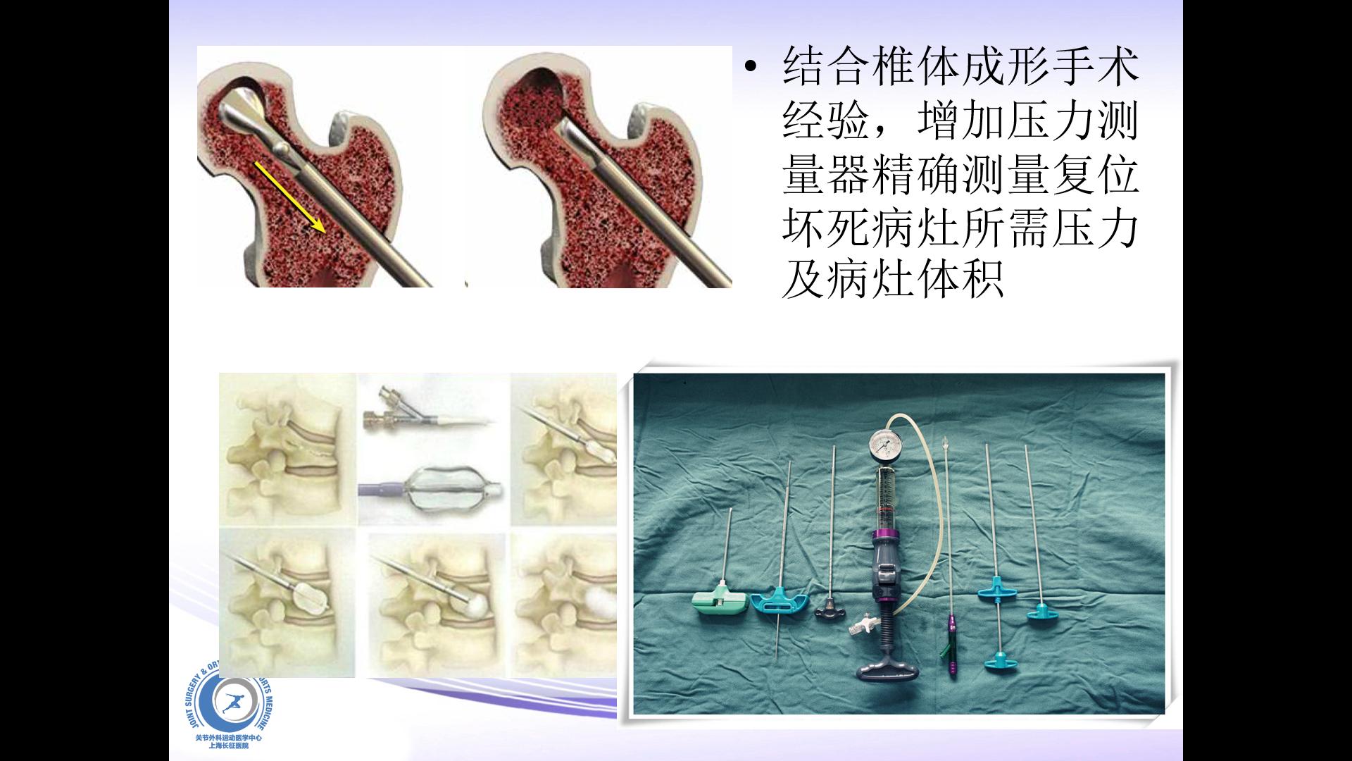 什么是股骨头坏死原因,股骨头坏死和股骨头缺血性坏死