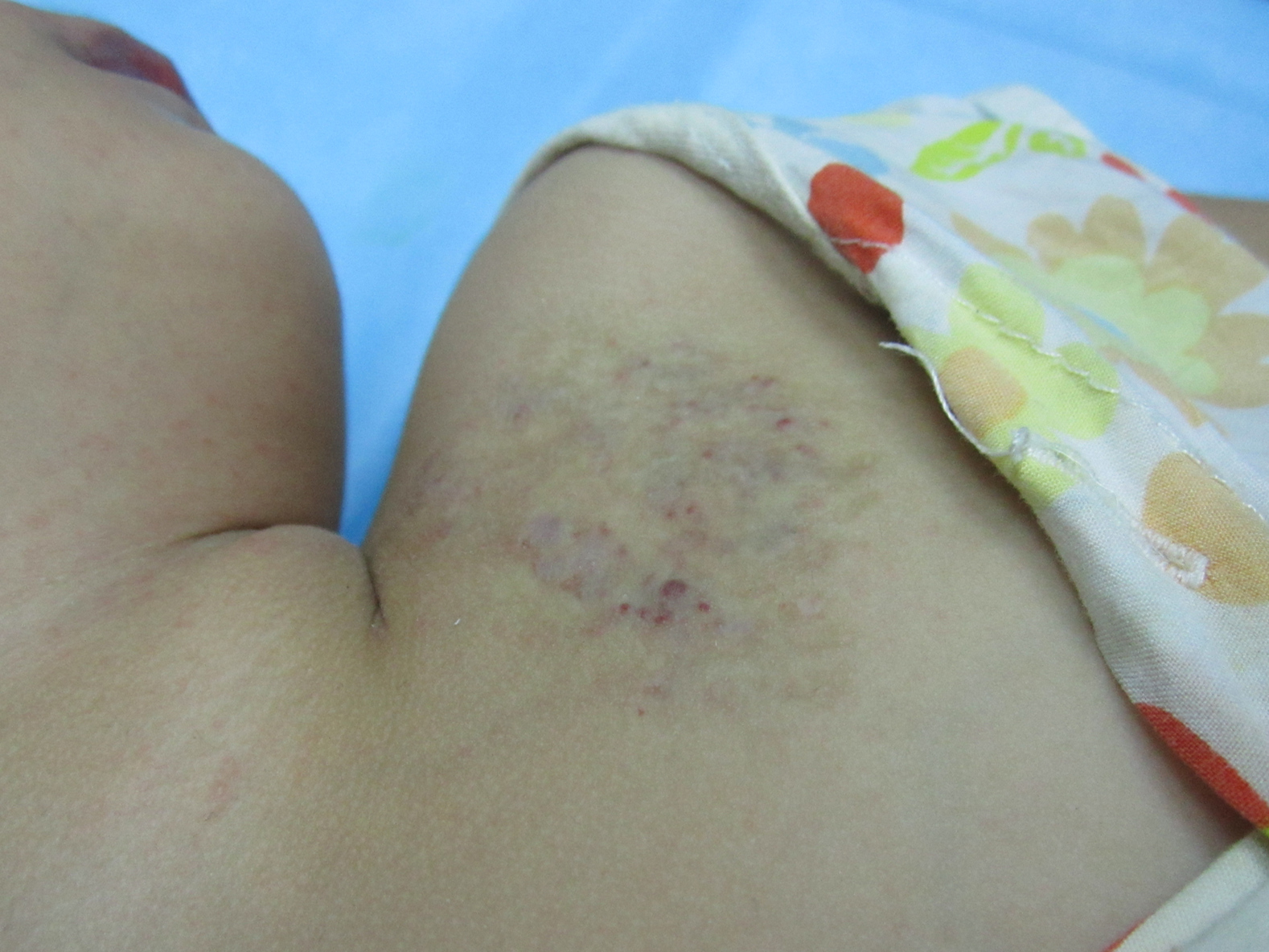 乳房血管瘤用什么方法治最好,乳房上有樱桃状血管瘤怎么治