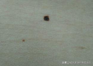 色素痣需要注意哪些事项,色素痣能怎么避免