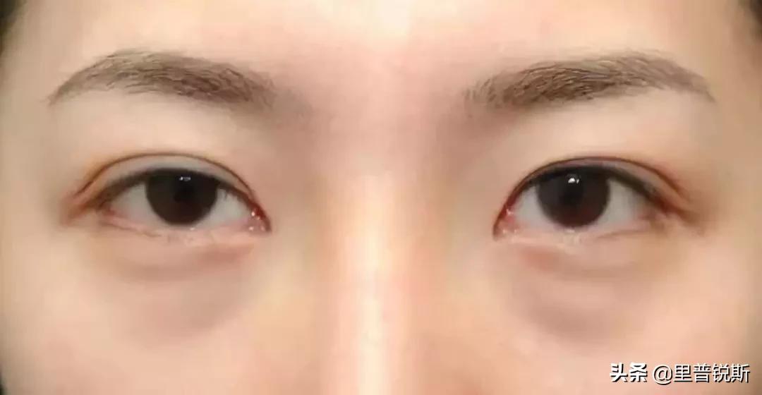 祖传药膏去除眼袋,祖传治疗眼袋