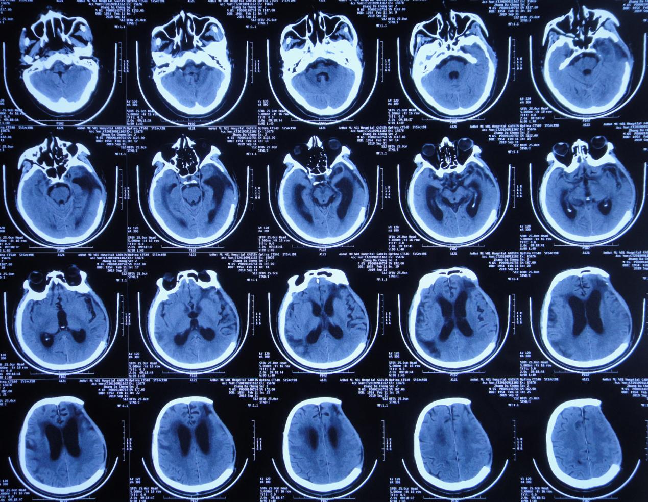 颅脑外伤术后脑积水,脑外伤脑积水颅骨缺失