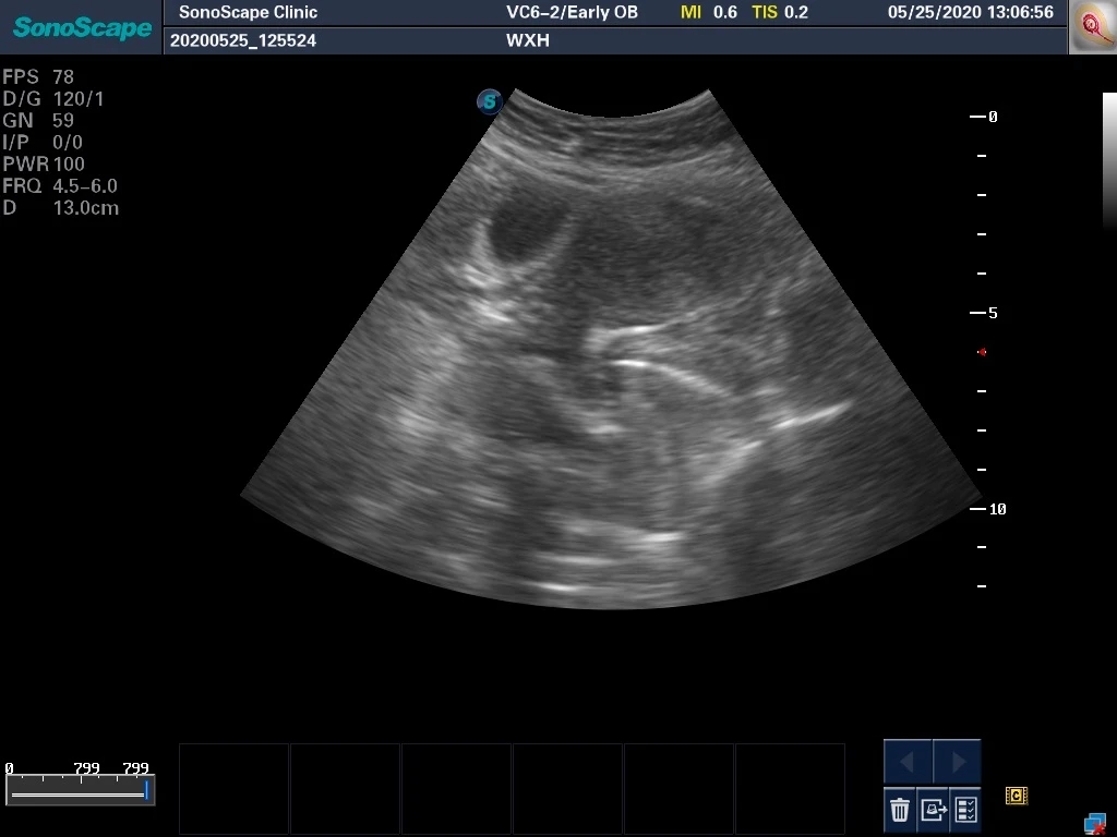 轻微宫腔粘连手术成功案例,轻度宫腔粘连分离术是大手术吗