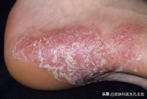 医院皮肤科医生治脚气用什么药,皮肤科医生脚气脚臭怎么办