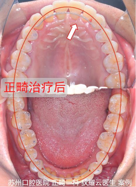 成人矫正期间牙齿松动正常吗,成年人牙齿矫正会松动吗