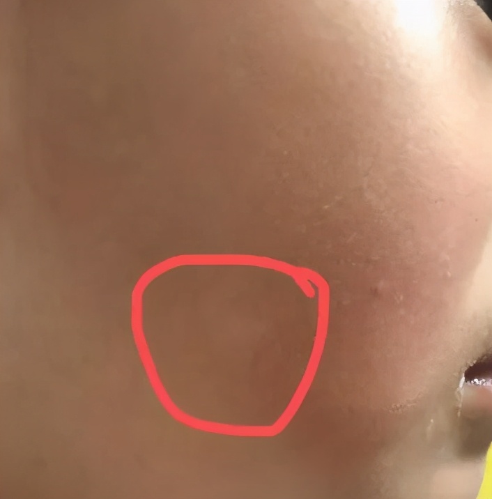 「患者咨询」回答一些近期患者提问的白斑问题