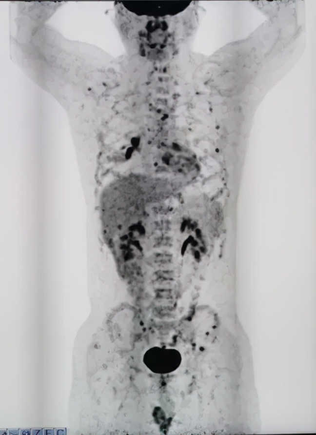 治疗后体温恢复,症状、影像仍进展,证据指向的感染竟只是迷障?