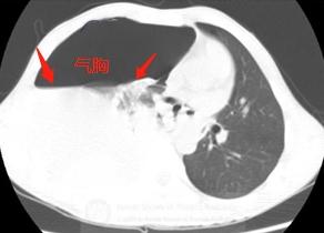 打个喷嚏结果鼻血流出来,打个喷嚏吐出一口血怎么回事