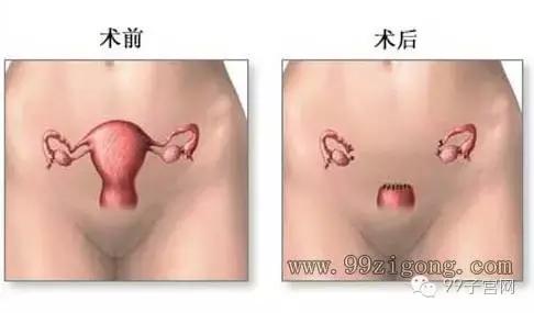 如果女人没有子宫会有什么影响,如果女人没子宫会怎样