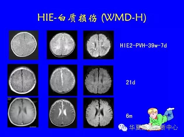 新生儿颅脑mri,新生儿颅脑mr报告模板