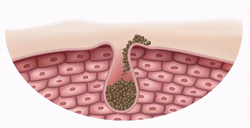 天一热脸上就长痘是怎么回事,天一热脸上就长粉刺