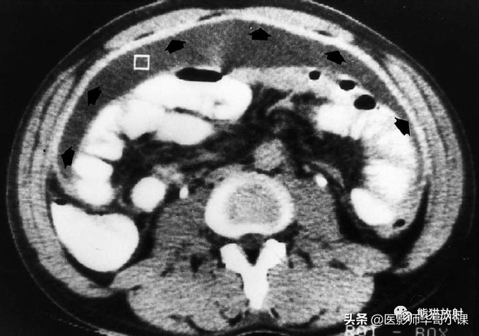 「精品课件」11种腹膜感染/炎症性病变的影像学表现