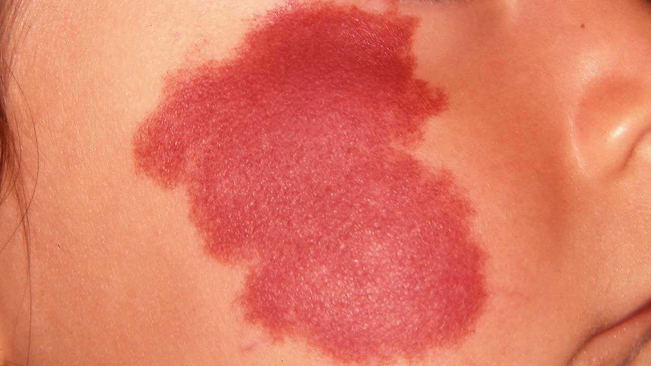 皮肤上长的红色像痣的是什么东西,头上长红色的肉痣是一种什么病吗