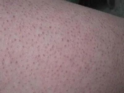 美背长痘,后背长痘的美背方法