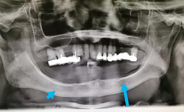 年轻人什么情况会牙齿掉光,30多岁牙齿掉光了是什么造成的