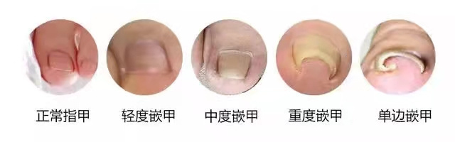 甲沟炎拔掉脚趾甲的过程,大脚趾甲重新长出来要多久