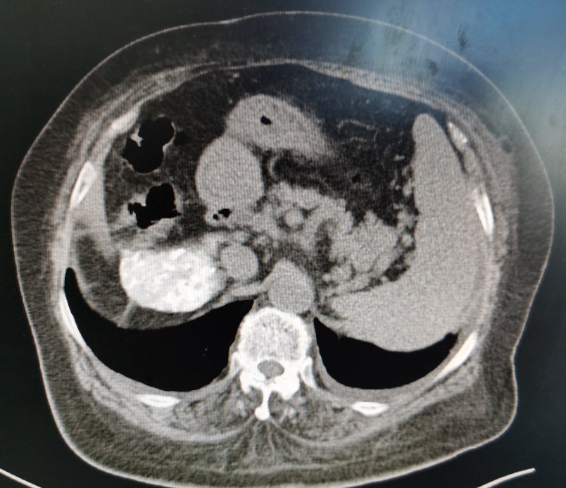 黄婶的肝癌用介入治疗已经3年多了-适合自己的治疗才是最好的治疗