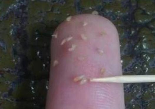 脸上粉刺留下硬块怎么去除,脸上一粒粒的粉刺怎么消除