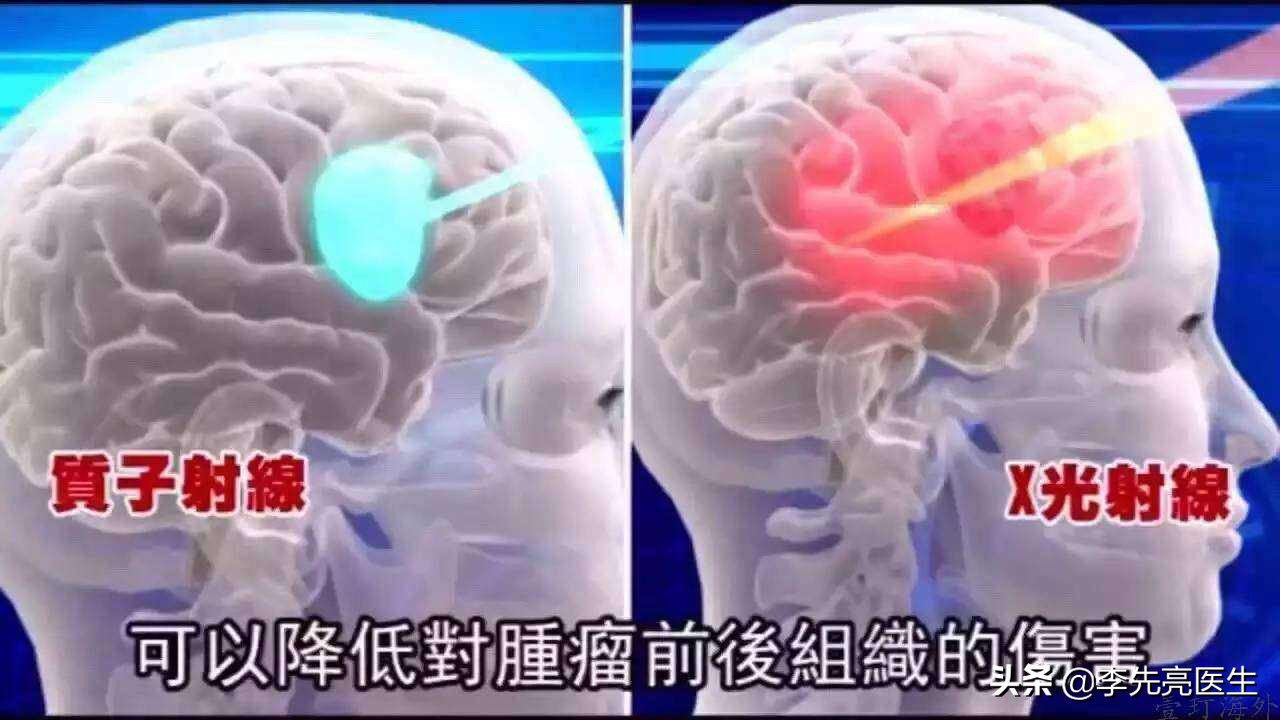 治疗癌症的质子仪,治癌新利器