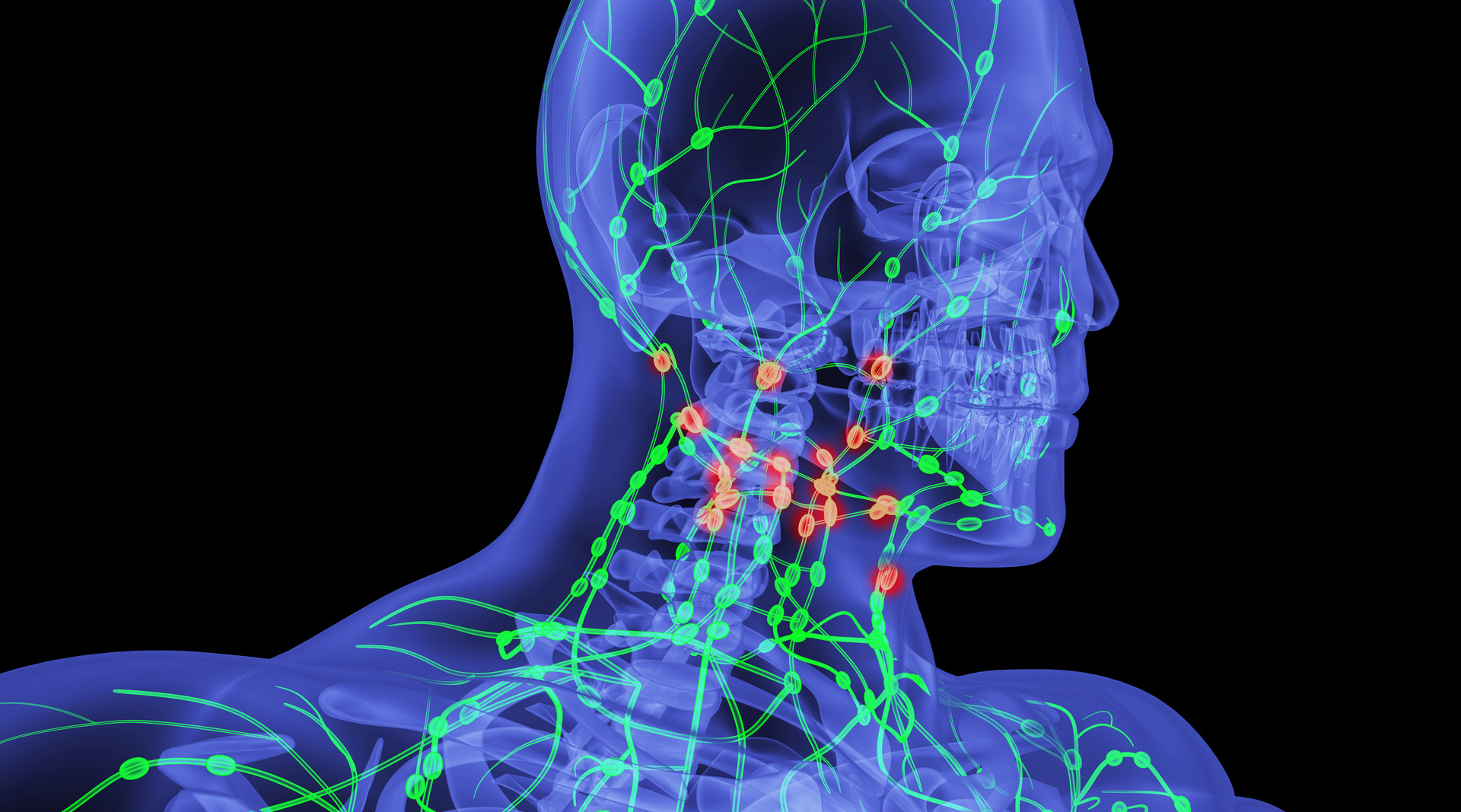 淋巴结肿大是癌细胞转移了怎么治,癌症转移到淋巴结用中药能消掉吗