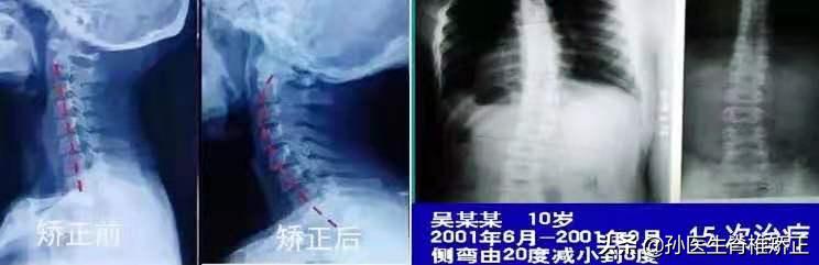 脊骨神经医学（美式脊椎矫正）精品课程