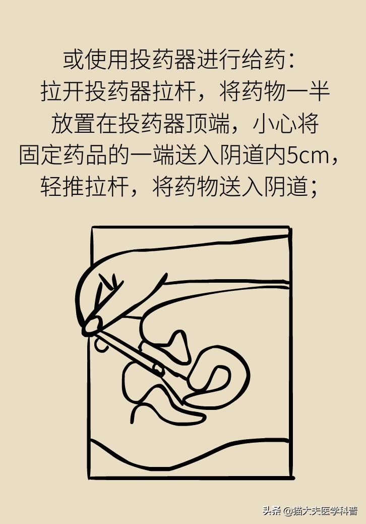 霉菌性阴道炎真的是里面“发霉”了吗？药师教你“抗霉”*法大**