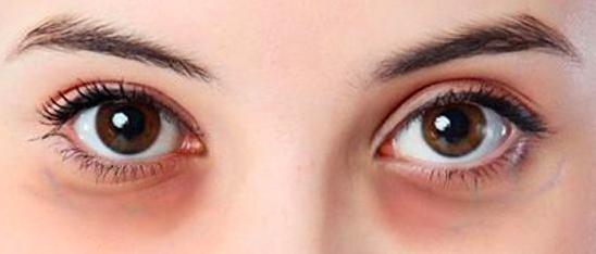 熬夜留下的黑眼圈怎么快速消除,熬夜看手机引起的黑眼圈可逆吗