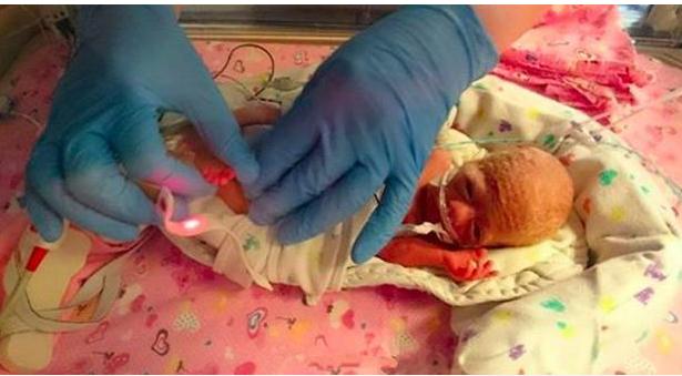 早产将近3个月,新生儿体重仅0.99斤却仍顽强存活,不禁让人感叹